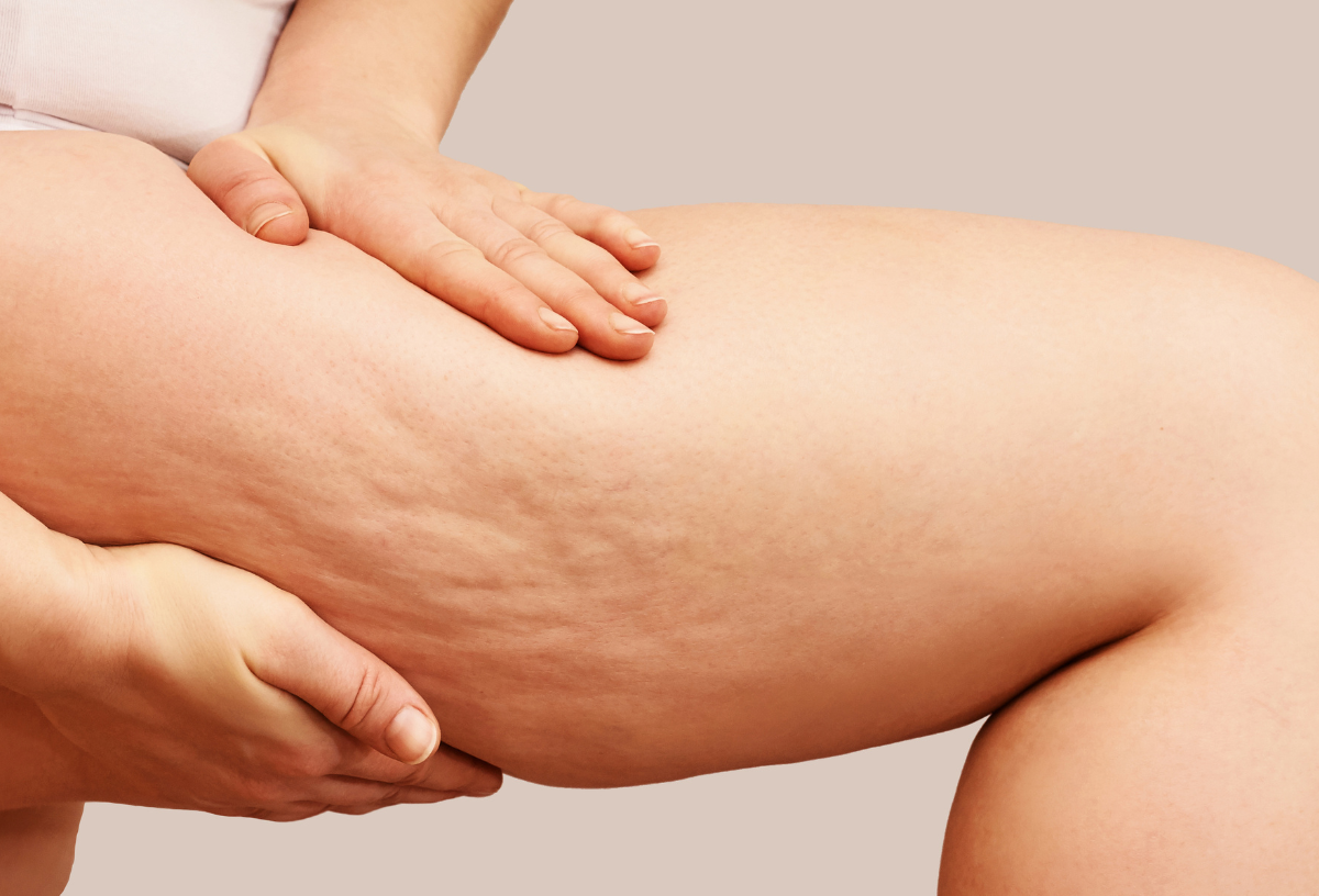 Cellulite Reduction